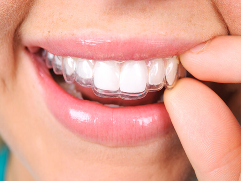 Traitement invisalign